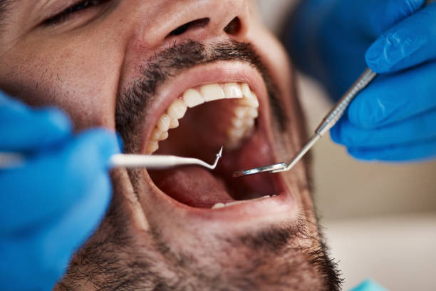 Dental Bonding in Russells Point, OH